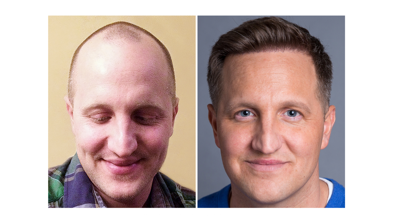 Man before and after hair restoration