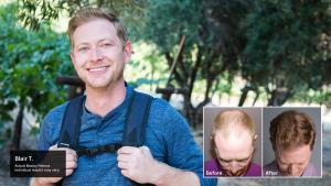 Man before and after hair restoration 