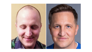 Hombre antes y después de la restauración capilar
